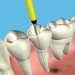 RootCanal2