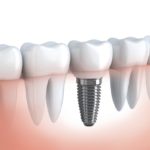 Tooth human implant (done in 3d graphics)