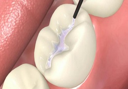 Dental-Sealants-1